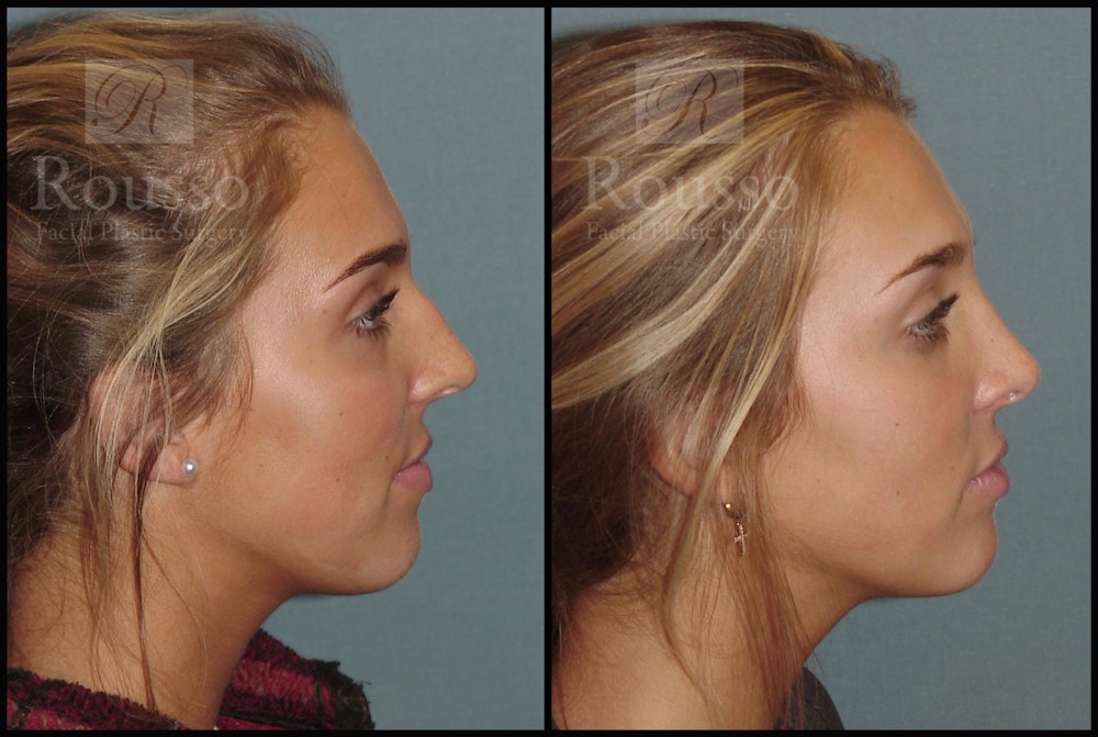 Rhinoplasty <span class=small>By Dr. Daniel Rousso</span> Before & After Gallery - Patient 7392509 - Image 1