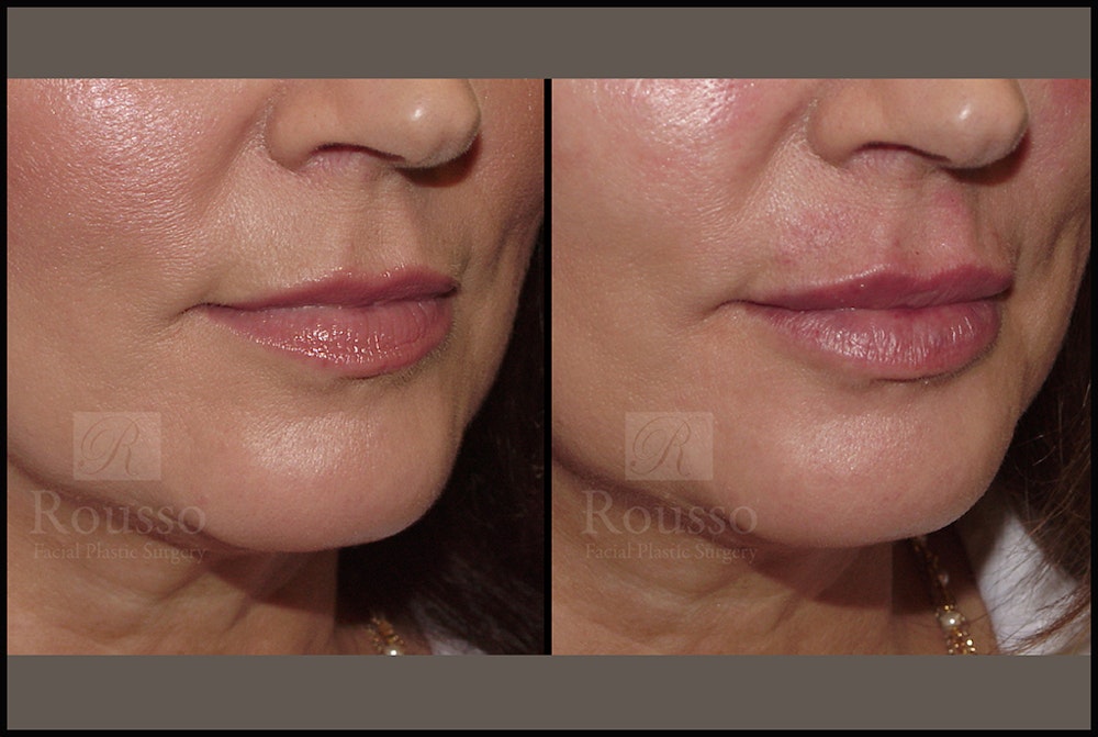 Fillers Before & After Gallery - Patient 7575267 - Image 1