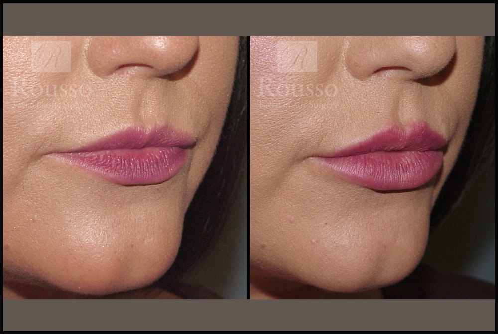 Fillers Before & After Gallery - Patient 7575889 - Image 1
