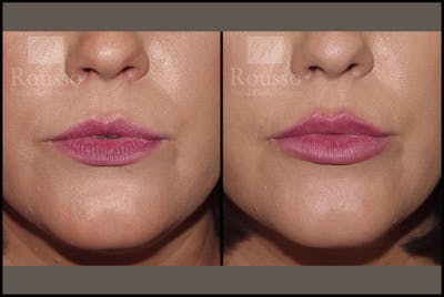 Fillers Gallery Before & After Gallery - Patient 7575889 - Image 2
