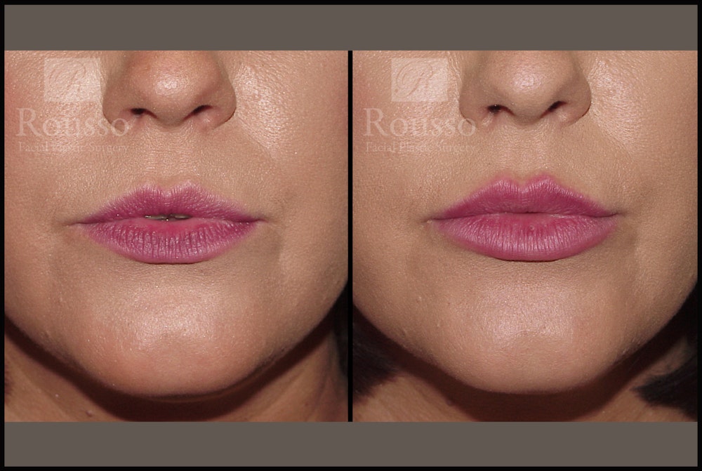 Fillers Before & After Gallery - Patient 7575889 - Image 2