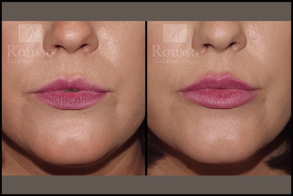Fillers Gallery Before & After Gallery - Patient 7575889 - Image 2