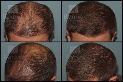 Hair Transplant Before & After Gallery - Patient 7809682 - Image 1