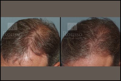 Hair Transplant Before & After Gallery - Patient 7809683 - Image 1