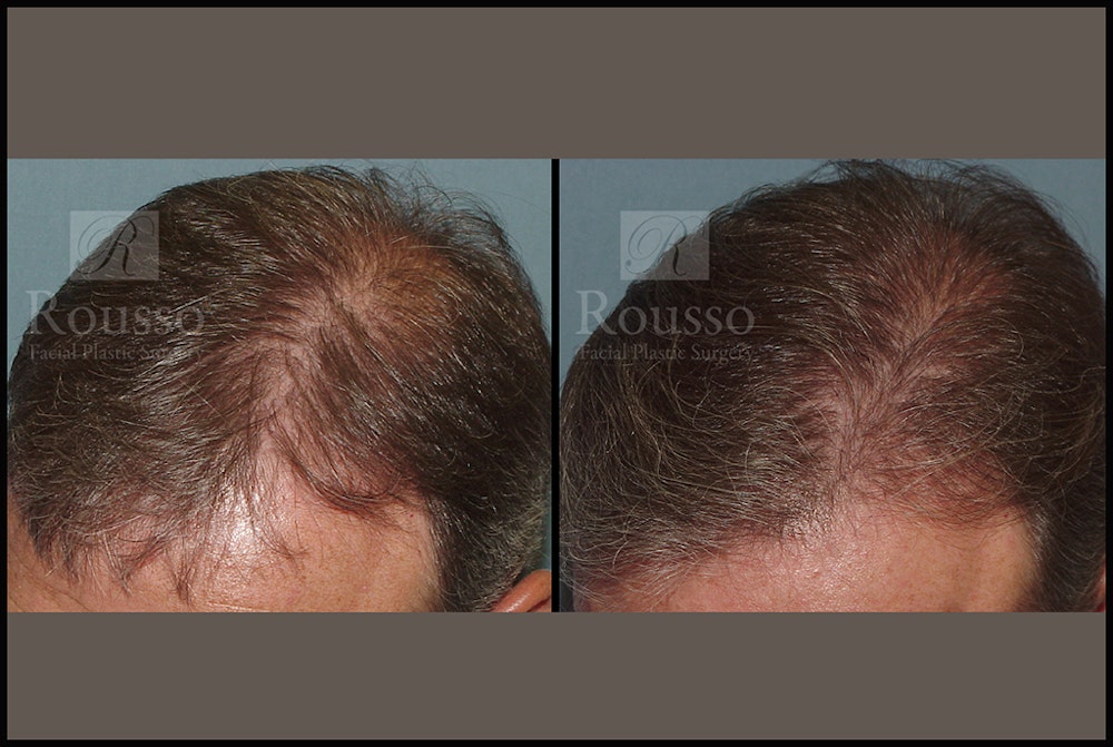 Hair Transplant Before & After Gallery - Patient 7809683 - Image 1