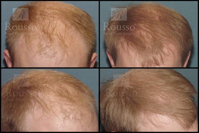 Hair Transplant Before & After Gallery - Patient 7809684 - Image 1