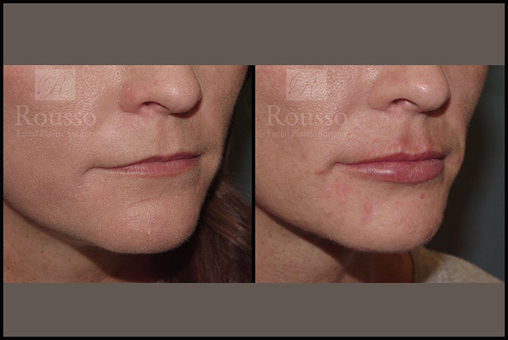 Fillers Before & After Gallery - Patient 9605871 - Image 1