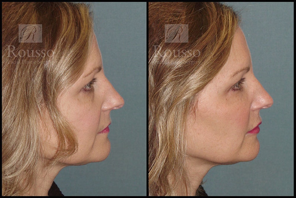 Liquid Facelift Gallery Before & After Gallery - Patient 9633094 - Image 3
