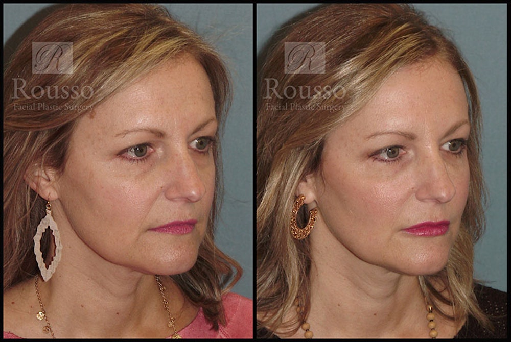 Liquid Facelift Before & After Gallery - Patient 9633094 - Image 1