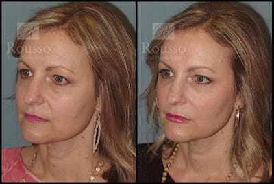 Liquid Facelift Gallery Before & After Gallery - Patient 9633094 - Image 2