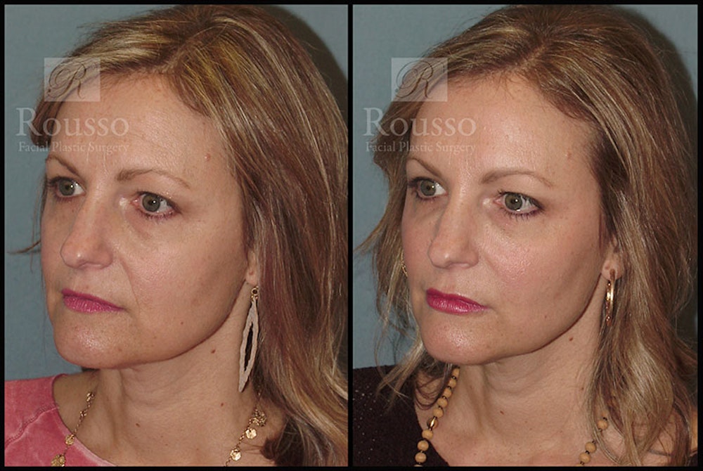 Liquid Facelift Before & After Gallery - Patient 9633094 - Image 2