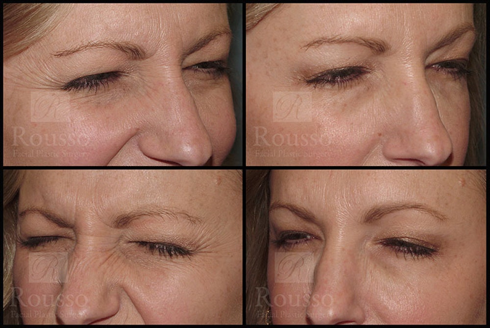 BOTOX Before & After Gallery - Patient 147738998 - Image 2