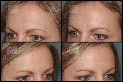 BOTOX Before & After Gallery - Patient 147738998 - Image 1