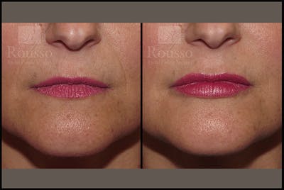 Fillers Gallery Before & After Gallery - Patient 9633107 - Image 1