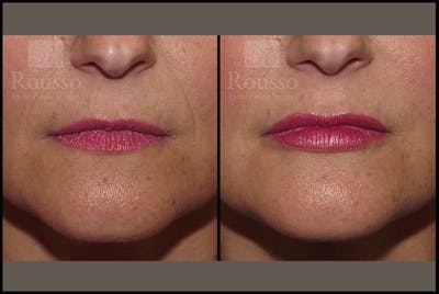 Fillers Before & After Gallery - Patient 9633107 - Image 1