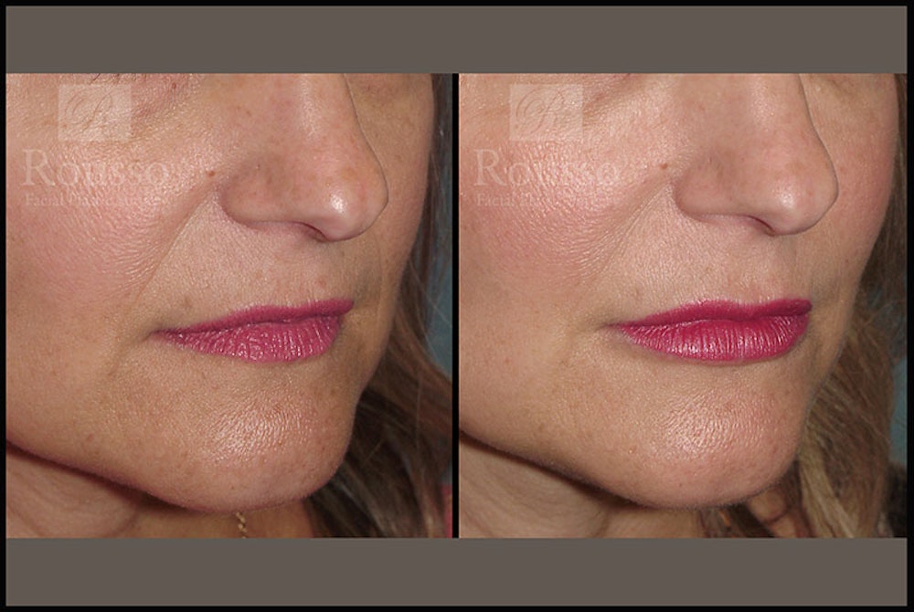 Fillers Gallery Before & After Gallery - Patient 9633107 - Image 2