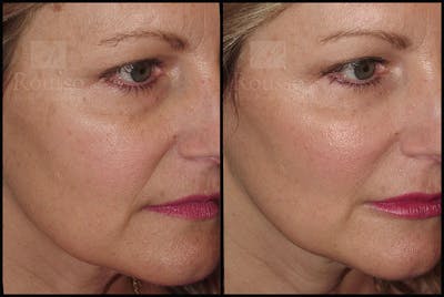 Fillers Gallery Before & After Gallery - Patient 9633108 - Image 1