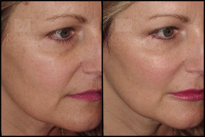 Fillers Before & After Gallery - Patient 9633108 - Image 1