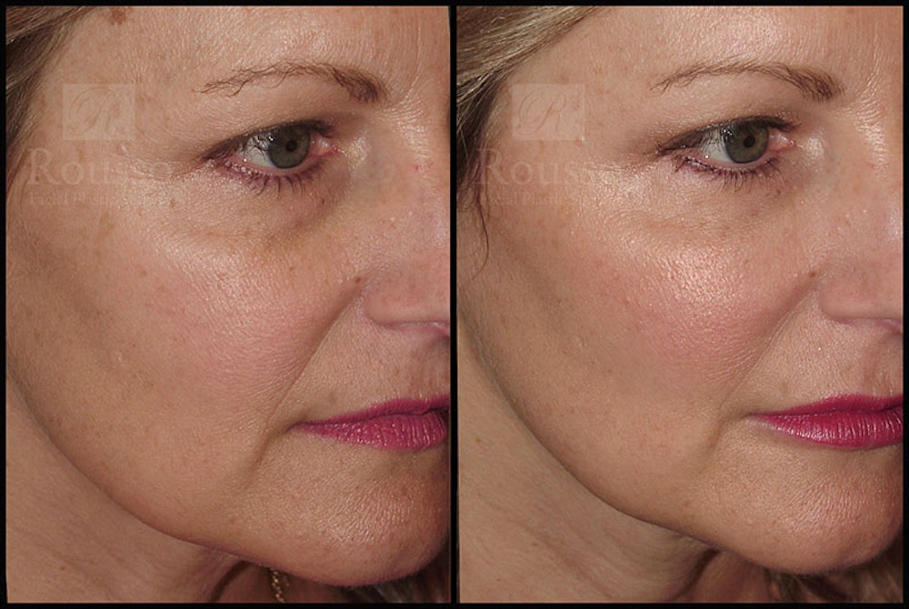 Fillers Gallery Before & After Gallery - Patient 9633108 - Image 1