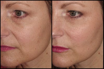 Fillers Before & After Gallery - Patient 9633108 - Image 2