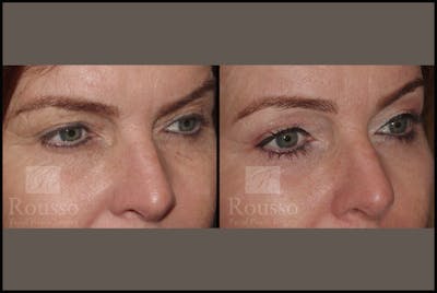 Blepharoplasty Before & After Gallery - Patient 10597772 - Image 2