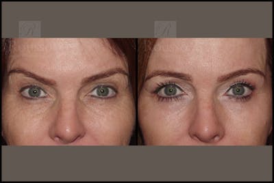 Blepharoplasty Before & After Gallery - Patient 10597772 - Image 1