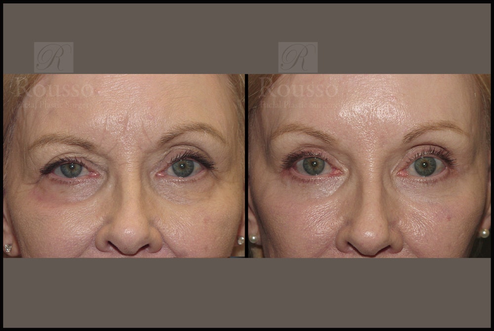 Blepharoplasty Before & After Gallery - Patient 10597773 - Image 1