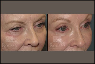 Blepharoplasty Before & After Gallery - Patient 10597773 - Image 2