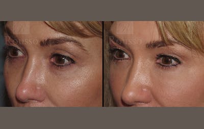 Fillers Before & After Gallery - Patient 10894412 - Image 1
