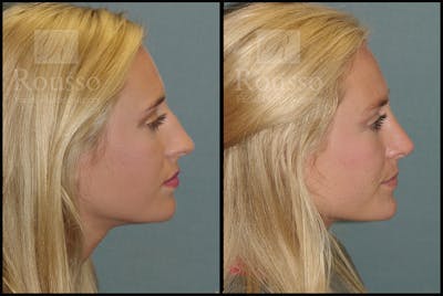 Rhinoplasty Before & After Gallery - Patient 17355878 - Image 1