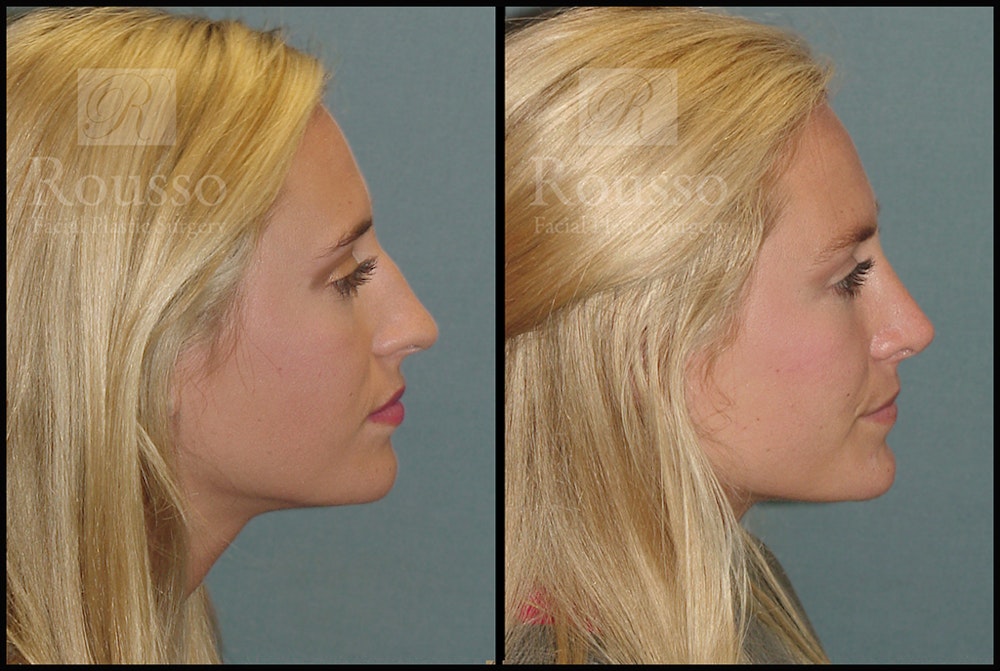 Rhinoplasty Before & After Gallery - Patient 17355878 - Image 1