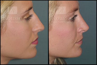 Rhinoplasty <span class=small>By Dr. Daniel Rousso</span> Before & After Gallery - Patient 17355878 - Image 4