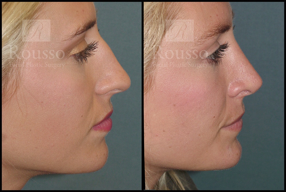 Rhinoplasty <span class=small>By Dr. Daniel Rousso</span> Before & After Gallery - Patient 17355878 - Image 4