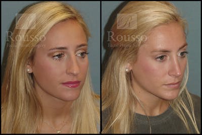 Rhinoplasty <span class=small>By Dr. Daniel Rousso</span> Before & After Gallery - Patient 17355878 - Image 2