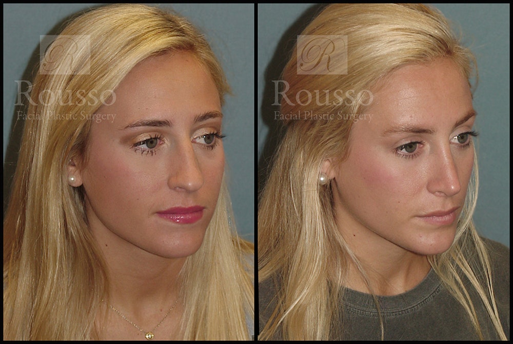 Rhinoplasty <span class=small>By Dr. Daniel Rousso</span> Before & After Gallery - Patient 17355878 - Image 2