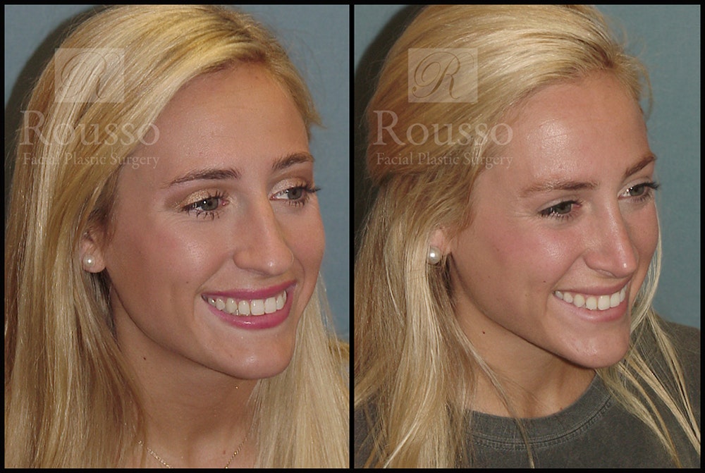 Rhinoplasty Before & After Gallery - Patient 17355878 - Image 2