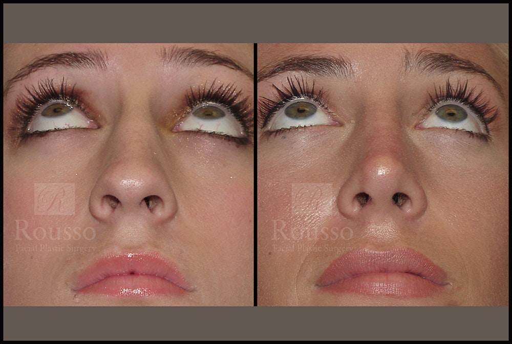 Rhinoplasty Before & After Gallery - Patient 17355878 - Image 5