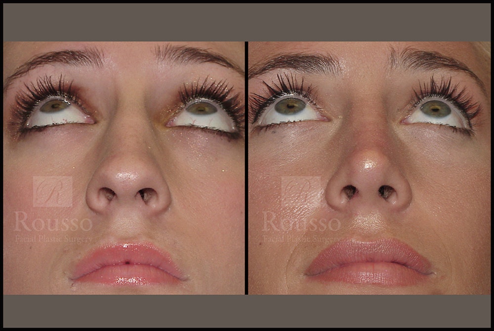 Rhinoplasty <span class=small>By Dr. Daniel Rousso</span> Before & After Gallery - Patient 17355878 - Image 5