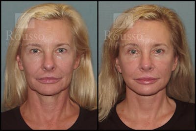 SculptLift™ Before & After Gallery - Patient 17927542 - Image 1