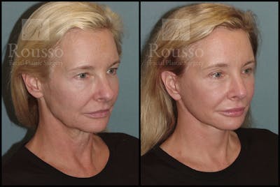 SculptLift™ <span class=small>By Dr. Daniel Rousso</span> Before & After Gallery - Patient 17927542 - Image 2