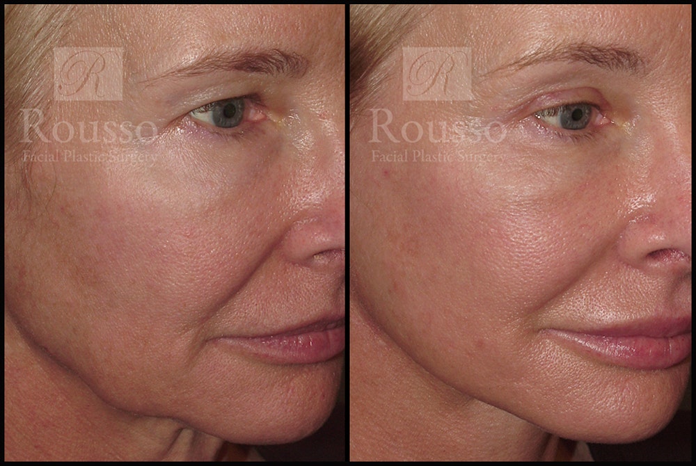 SculptLift™ Before & After Gallery - Patient 17927542 - Image 3