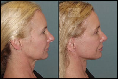SculptLift™ Before & After Gallery - Patient 17927542 - Image 4