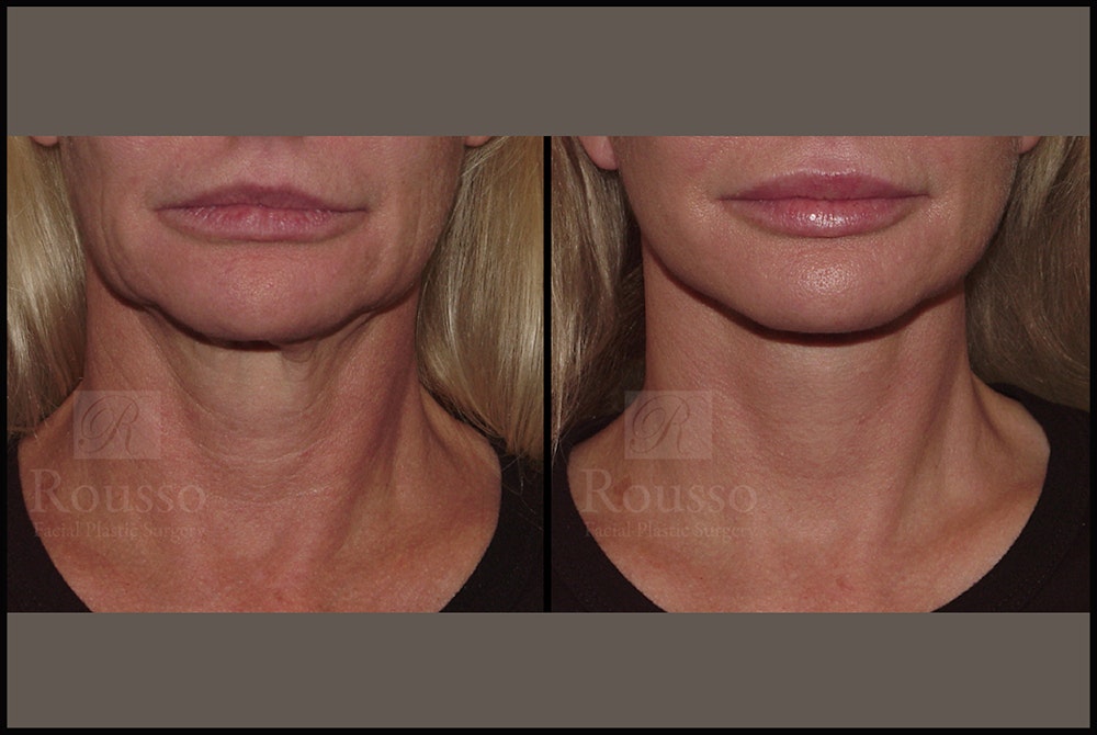 SculptLift™ <span class=small>By Dr. Daniel Rousso</span> Before & After Gallery - Patient 17927542 - Image 5