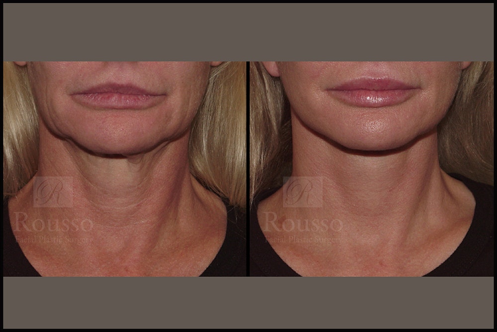 SculptLift™ Before & After Gallery - Patient 17927542 - Image 5