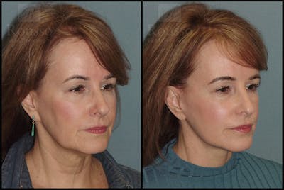 Facelift Before & After Gallery - Patient 18906429 - Image 1