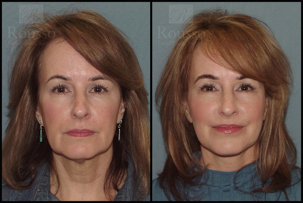 Facelift Before & After Gallery - Patient 18906429 - Image 3