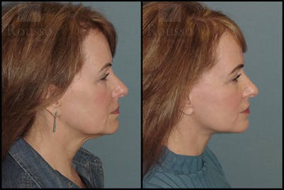 Facelift Before & After Gallery - Patient 18906429 - Image 2