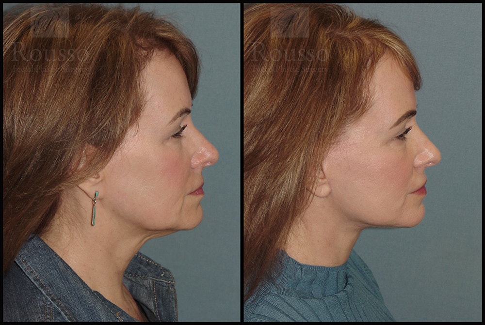 Facelift Before & After Gallery - Patient 18906429 - Image 2