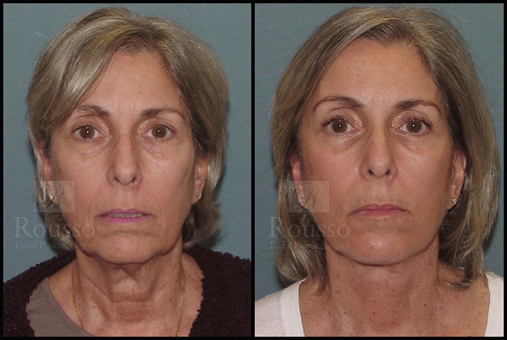 Facelift Before & After Gallery - Patient 24558324 - Image 3