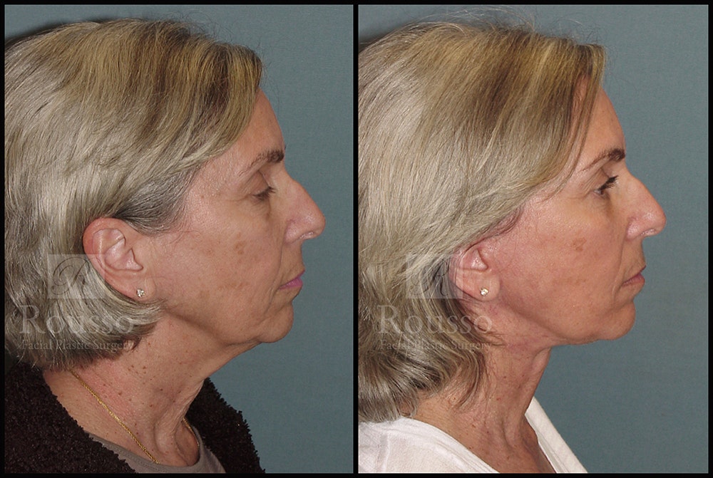 Facelift Before & After Gallery - Patient 24558324 - Image 2